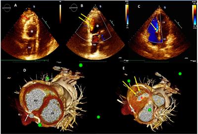 Case Report: Coil Occlusion of Two Congenital Coronary Cameral Fistulas Connecting Right and Left Circumflex Arteries to the Right Ventricle: An Innovative Stent-Assisted Technique